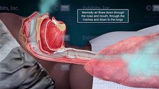 Animating Flow in 3-D Medical Animation Trial Presentations