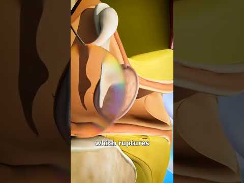 Why Eardrum Burst From Loud Noise