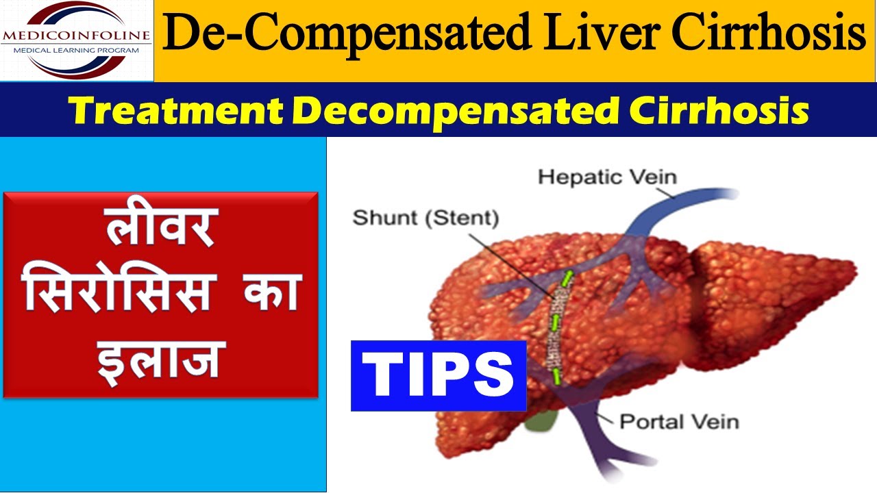 Decompensated Liver Cirrhosis Decompensated Liver Disease YouTube Decompensated Liver Cirrhosis Decompensated Liver Disease YouTube
