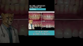 앞니 깨짐, 신경치료 없이 크라운으로 해결! 🦷 #앞니치료 #크라운치료 #치아깨짐 #shorts
