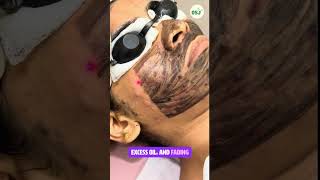 Acne Treatment Transformation ✨ Clear Skin Starts Here!