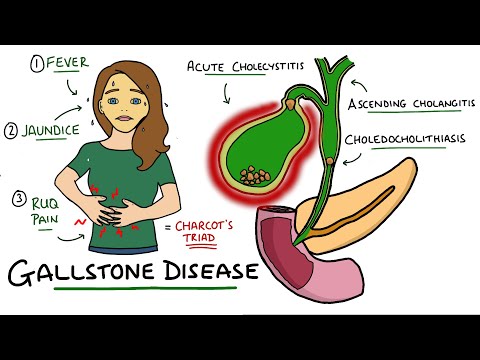 Gallstone Disease - Acute Cholecystitis vs Cholelithiasis vs Choledocholithiasis vs Cholangitis