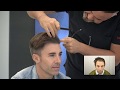 6600 (3200+3400) Grafts Manual FUE Hair Transplant Result