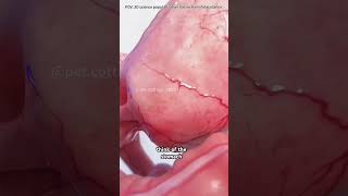 Endoscopic sleeve gastroplasty #motivation #doctor #3danimation