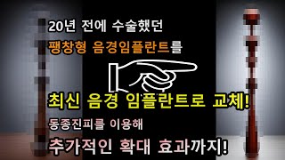 20년간 사용했던 음경임플란트를 사용감 좋은 최신 팽창형 음경 임플란트로 교체 + 동종진피 음경확대술까지! 하나의 절개창으로 수술! (vertical incision method)