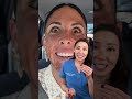 TCA Chemical peel