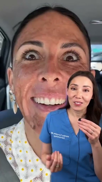 TCA Chemical peel