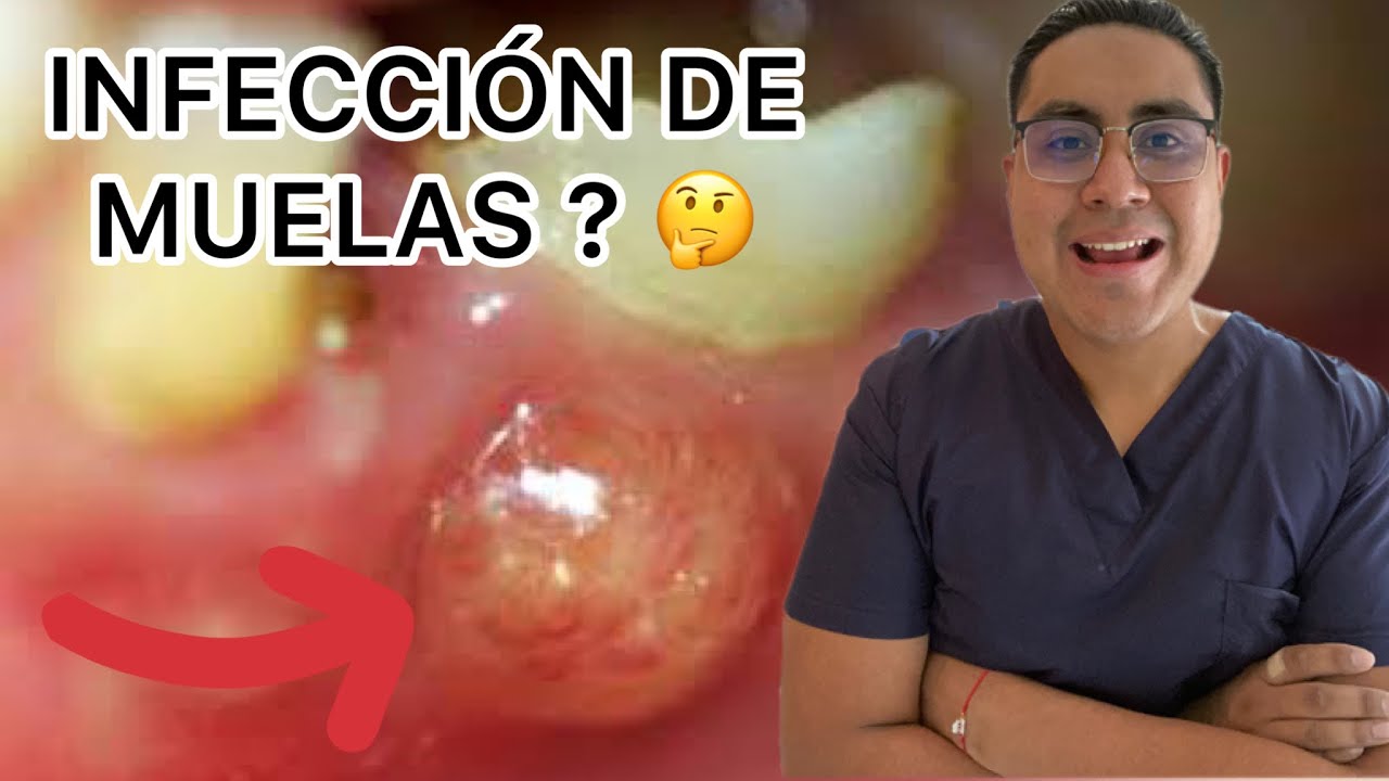 Infección dental- Dolor de muelas ? - Como identificarlo ? - YouTube