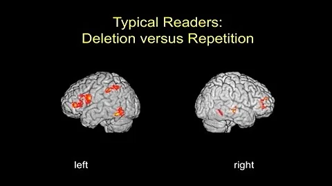 Brain Imaging Studies of Reading and Reading Disability