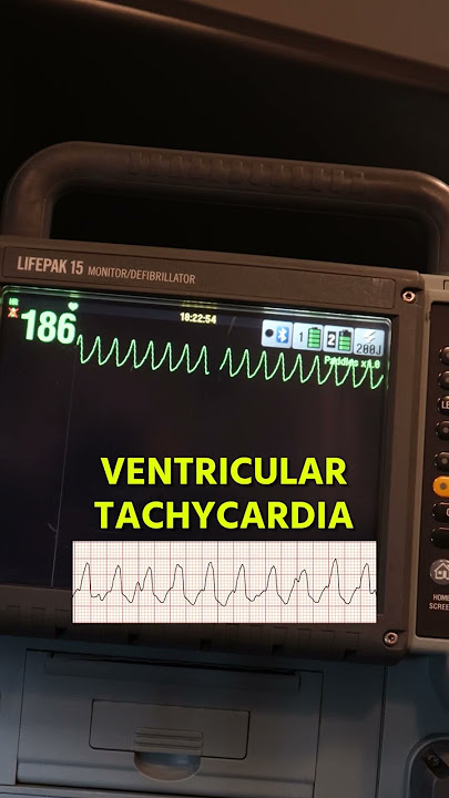 LIVE Ventricular Tachycardia Spotted...
