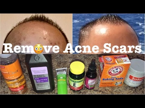 📒How to Remove Acne Scars, Dark Age Spots, or Uneven Skin Tone Review | Best  Acne Scar Products