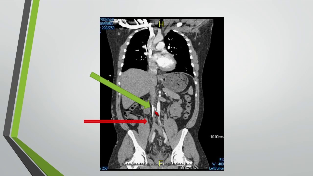 Case Selection & Technical Consideration When Treating Chronic Venous Occlusion - Munier Nazzal, MD