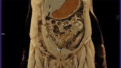 Colitis with Cinematic Rendering
