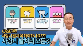 사랑니 발치 반드시 해야하나요?? 사랑니 발치의 모든것 - 수면사랑니발치까지