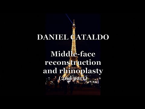 Middle face reconstruction and rhinoplasty 2