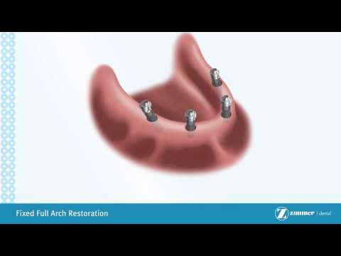 Introduction to Hybrid Implant Dentures