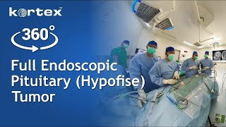 360⁰ KORTEX Endoscopic for Pituitary Tumor (Hypofise) Performed by dr. Agus ACA