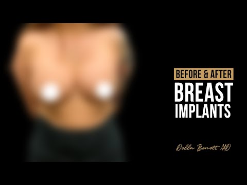 Before After Breast Augmentation, Breast Lift & Internal Bra/Mesh #6008 ·  Della Bennett MD 