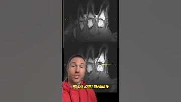 Real MRI Of Joint Cracking!💥