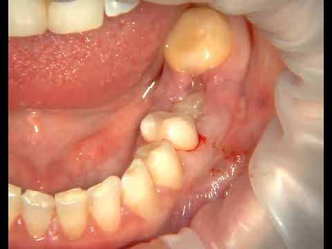 Video: Alveolit (lunga) - Orsaker, Symtom, Komplikationer Och Behandling Av Alveolit