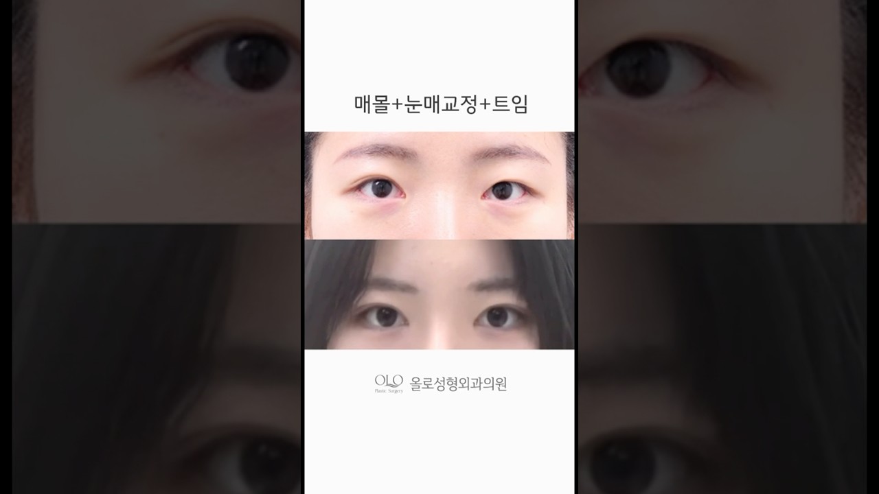 [OLOL Plastic Surgery] Ánh mắt rõ nét🤍 Vì phẫu thuật mắt OLOL khác biệt #phauthuatmat #reviewsieumat