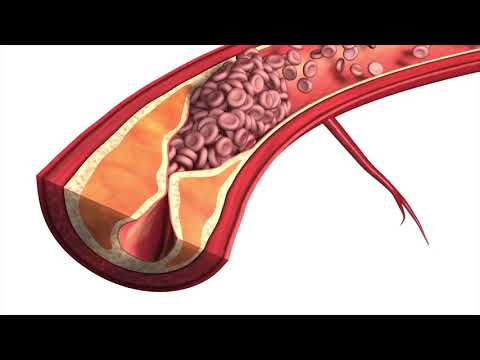 Dr Miloš Sladojević - Karotidna arterija