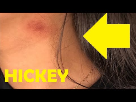 how to give someone a hickey on the neck easy