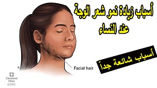 أشهر أسباب زيادة نمو شعر الوجه عند النساء و طرق العلاج
