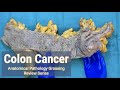 Colon cancer  anatomical pathology grossing review series