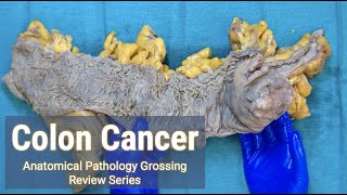 Colon Cancer | Anatomical Pathology Grossing Review Series