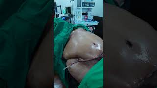 100kg Weight Patient Tummy Tuck surgery Result #shorts screenshot 4