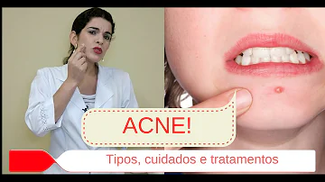 Como descobrir meu tipo de acne?