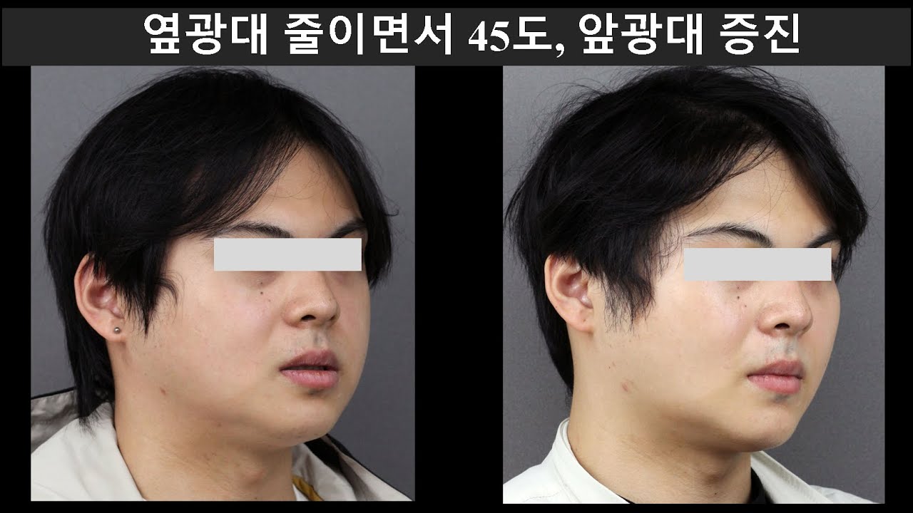 옆광대 줄이면서 45도, 앞광대 증진 (Side Zygoma Reduction with 45° & Front Zygoma Enhancement)