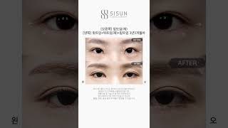 [B&amp;A] (오른쪽) 앞트임 재수술 (양쪽) 윗트임+뒤트임 재수술+밑트임 3년5개월차