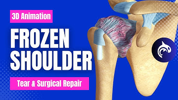 Frozen Shoulder (Adhesive Capsulitis)