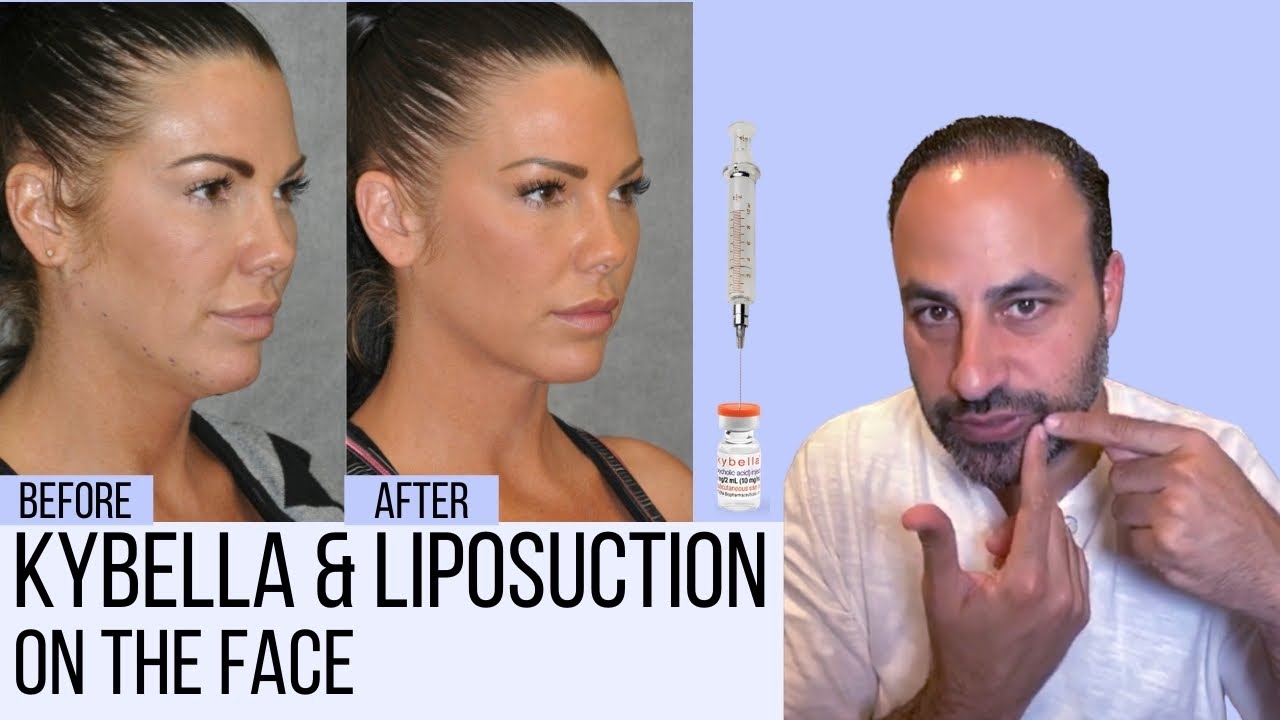 What You Need to Know About Liposuction & Kybella in the Face