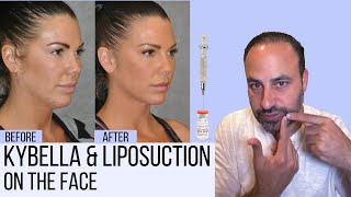 What You Need To Know About Liposuction & Kybella In The Face