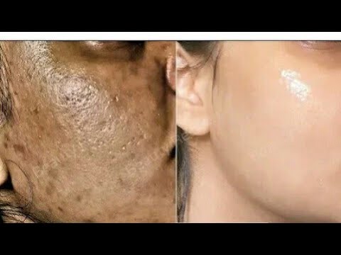 dewsoft cream for acne