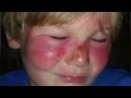 3-Year-Old Boy Gets Second-Degree Burns On Face Despite Using Sunscreen