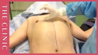 【男性の脂肪吸引】お腹の筋肉をデザインした施術直後動画