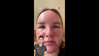 What Sun Poisoning Really Looks Like What Do You Do About Sun Poisoning