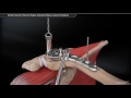 Distal Clavicle Fracture Repair Using Coracoid Fixation