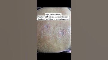 Thumbnail of Chickenpox and Acne Scar Treatment using Targeted Fractional CO2 Laser #acnescars #skincare