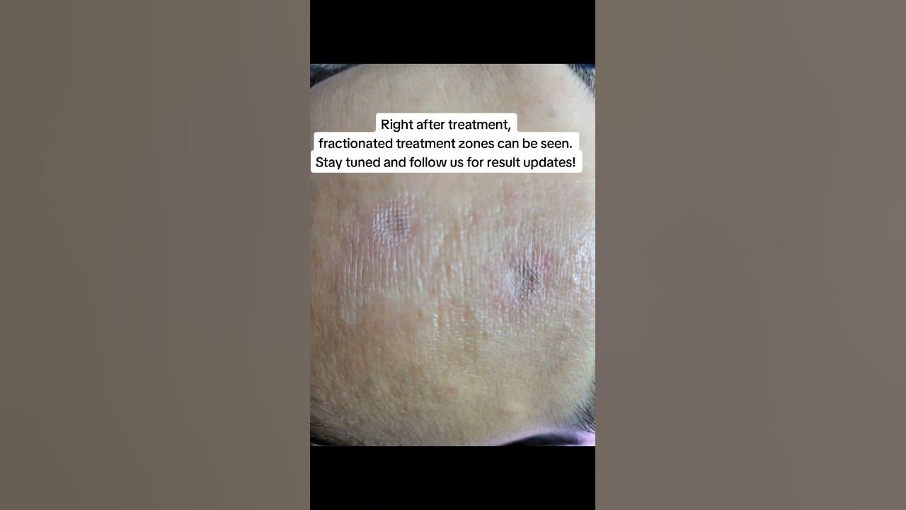Chickenpox and Acne Scar Treatment using Targeted Fractional CO2 Laser #acnescars #skincare