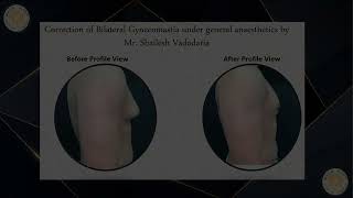 Before and After Pictures of Gynaecomastia at MACS Clinic Watford Performed by Mr Shailesh Vadodaria