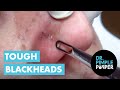Dr pimple popper vs tough blackheads