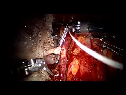 Video: Anastomosis I - Glosarium Istilah Medis