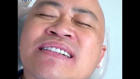 INVISALIGN kết hợp cùng DÁN SỨ VENEER cho nụ cười hoàn hảo