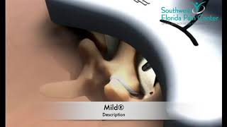 The Mild® Procedure
