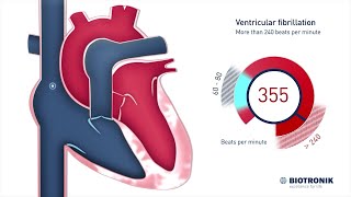 Fibrillation ventriculaire et arrêt cardiaque soudain